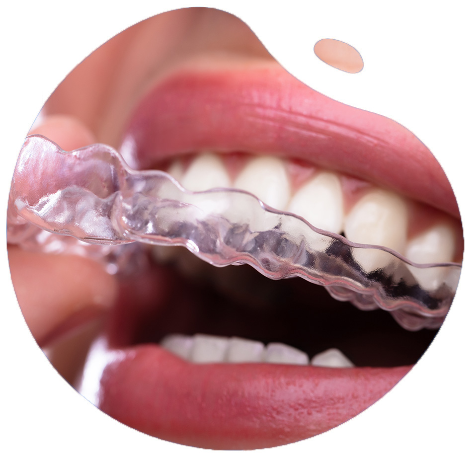 https://www.hebronsmiles.com/wp-content/uploads/2021/11/choose-clear-aligners-to-straighten-the-smile.jpg