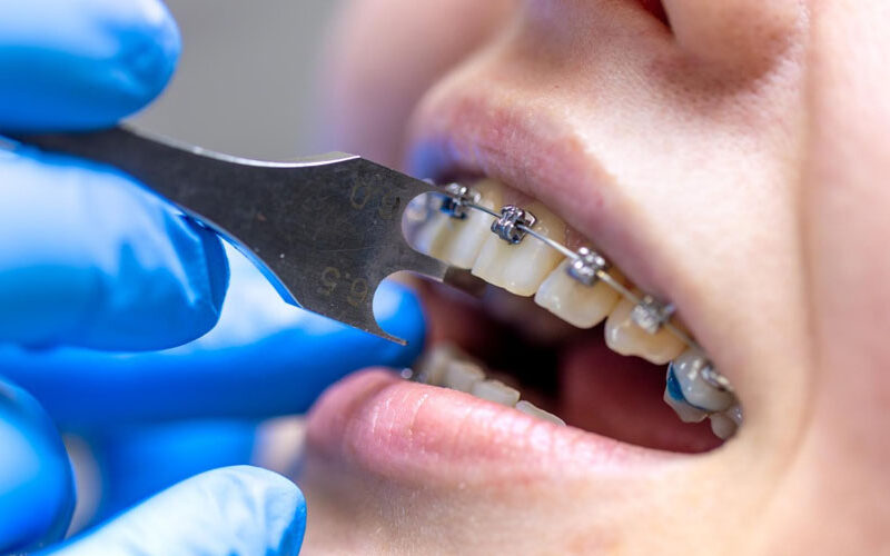 Complete Guide to Orthodontic Treatment: Types, Benefits & Treatment Process