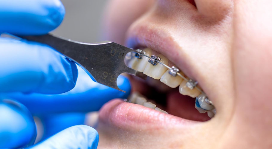 complete-guide-to-orthodontic-treatment-types-benefits-treatment-process