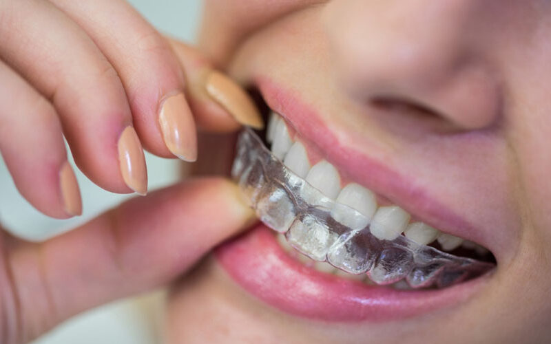 How Clear Aligners Work: A Step-by-Step Guide