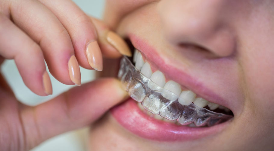 How Clear Aligners Work: A Step-by-Step Guide