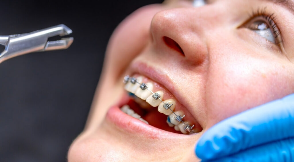 5 Signs You Need Orthodontic Treatment (And What Happens If You Wait)