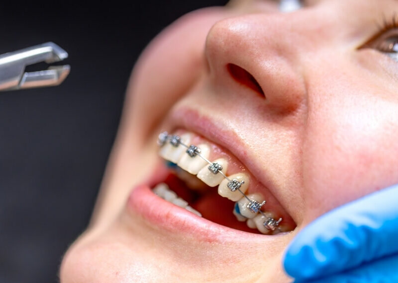5 Signs You Need Orthodontic Treatment (And What Happens If You Wait)